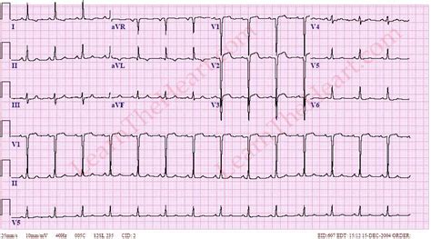 lv aneurysm ecg|what is ventricular aneurysm.